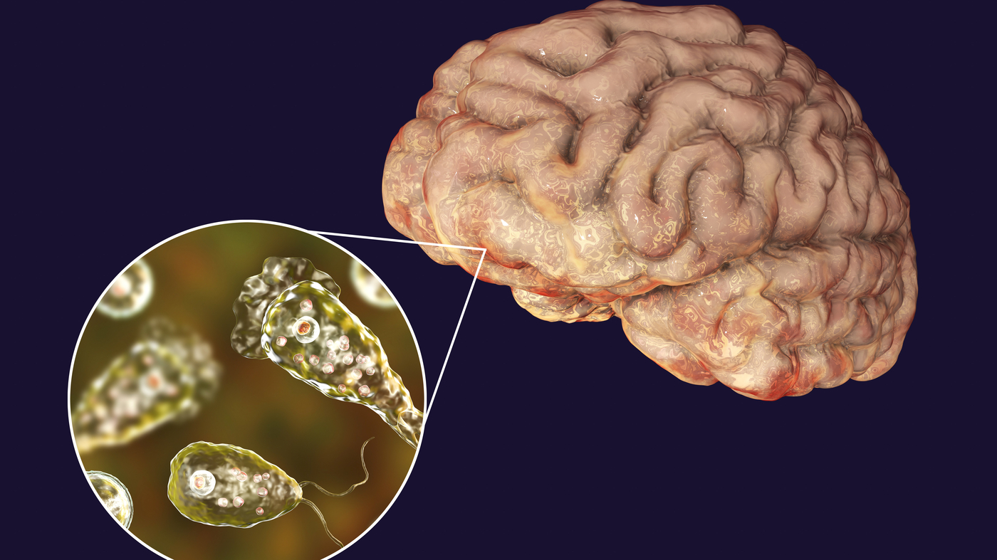 Brain-eating amoeba infection, illustration